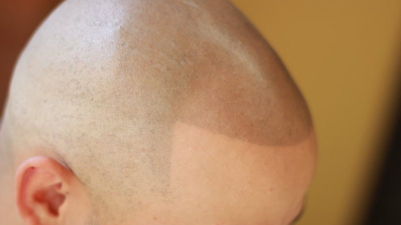 Scalp Micro pigmentation