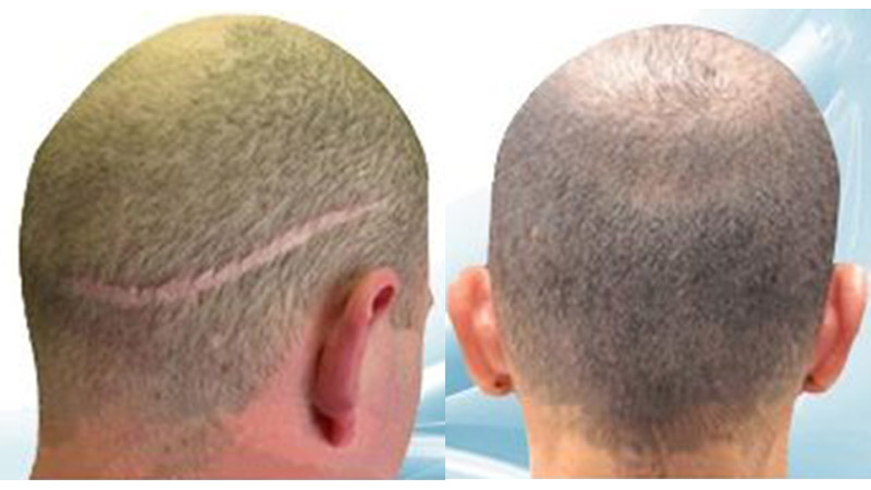 FUT Hair Transplant